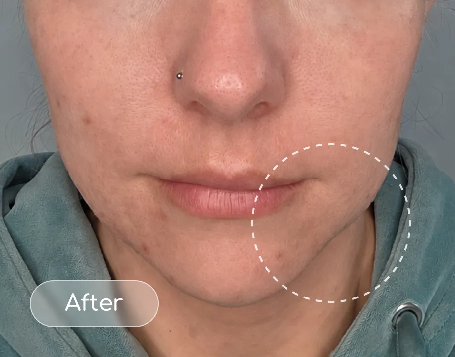 Breakouts after