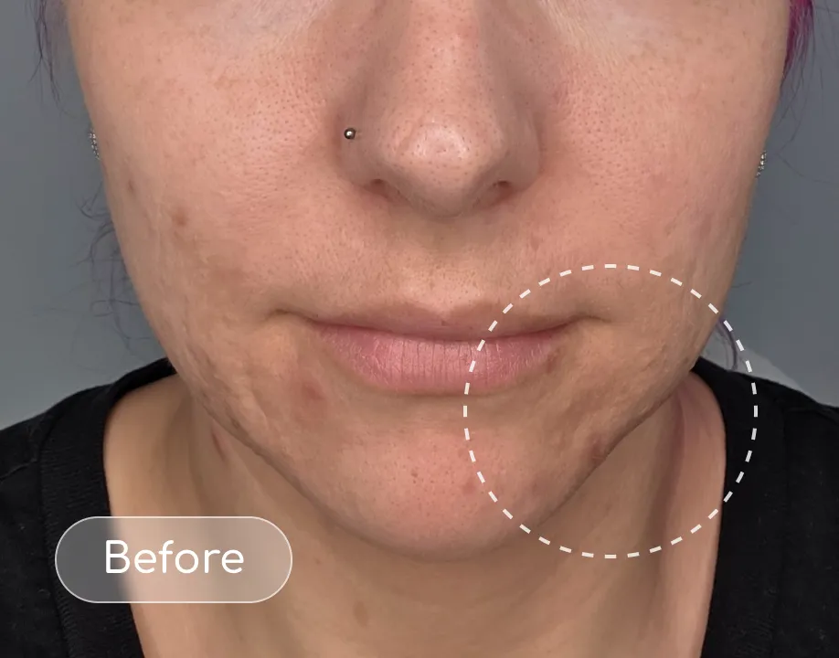 Breakouts before