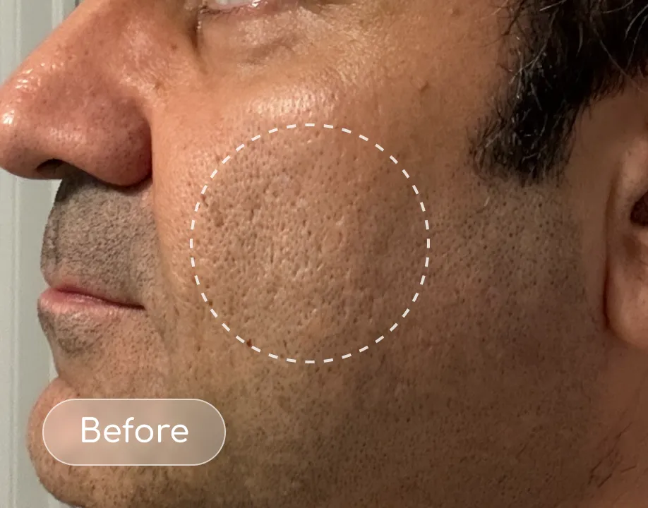 Pores before