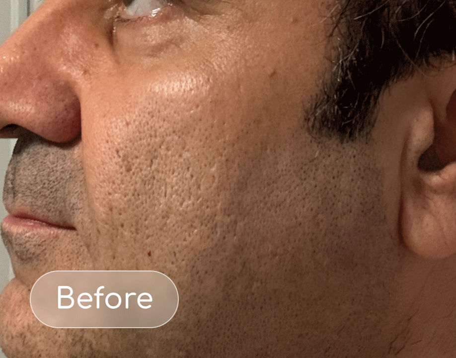 Pores before