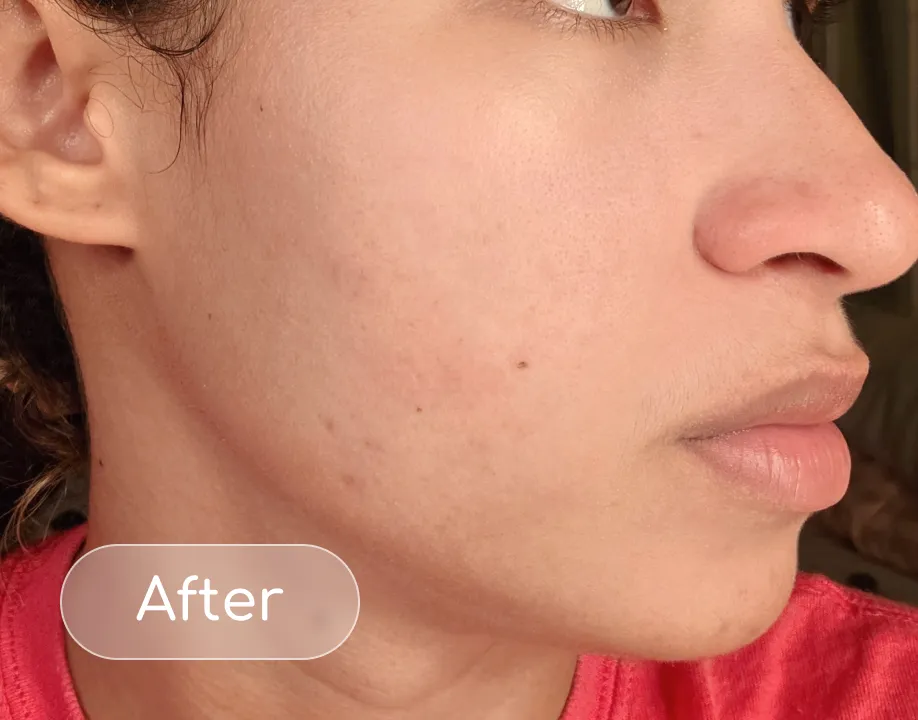 Breakouts after