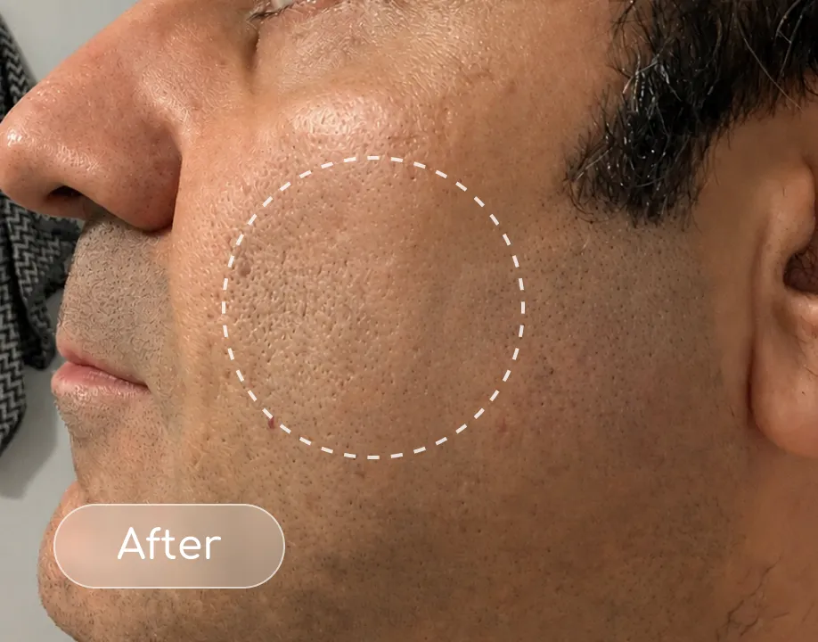 Pores after