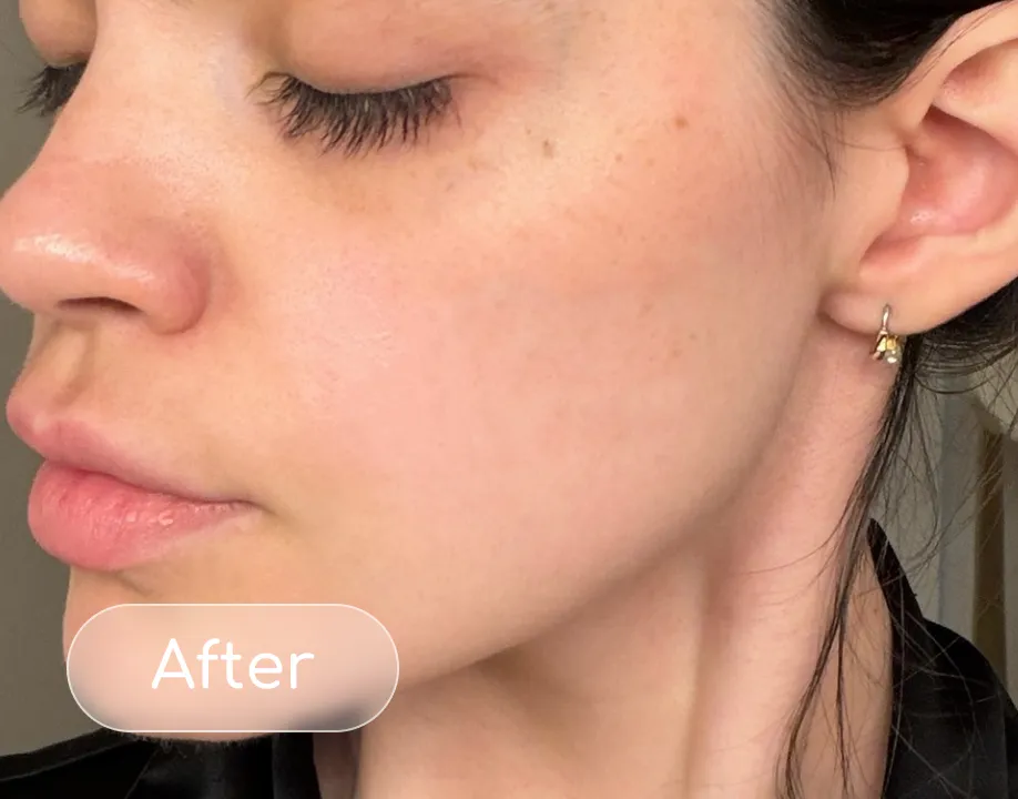 Redness after
