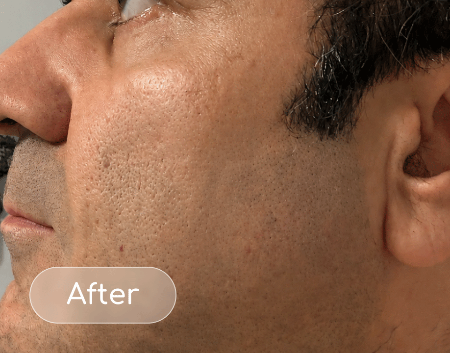 Pores after